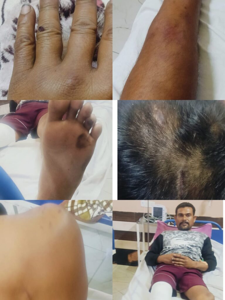उचगांव चौकी के सामने दबंगों का तांडव: बेटे को पीटने के बाद मां से लूट, पुलिस पर कार्रवाई न करने का आरोप