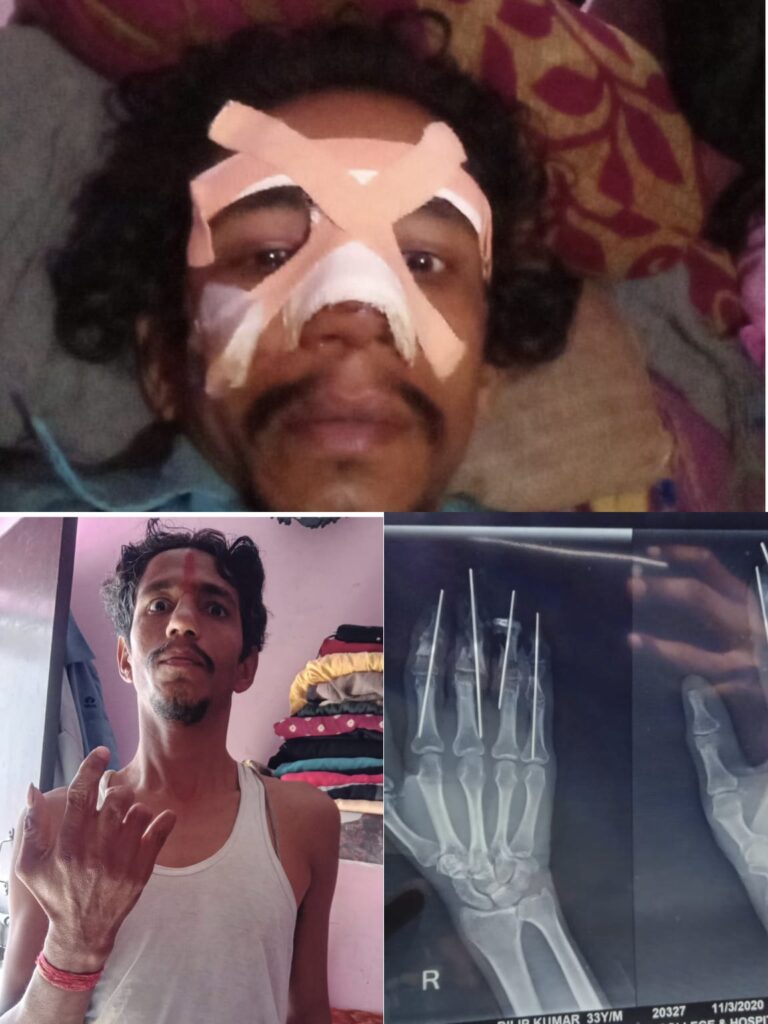 फैक्ट्री हादसे के बाद मजदूर को नौकरी से निकाला, मुआवजा और ईएसआई तक नहीं: गार्ड से पिटवाने का आरोप, न्याय के लिए दर-दर भटक रहा दिलीप